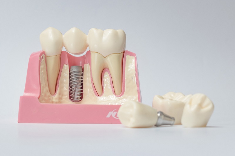 Zubni implantati rijeka
